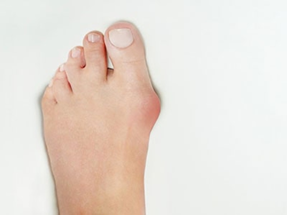 south florida podiatry bunions in Lake Worth Florida