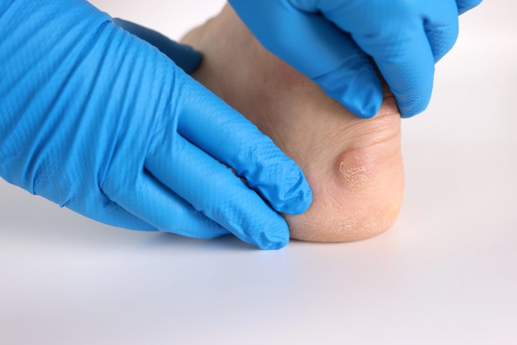 south florida podiatry corns in sunrise florida
